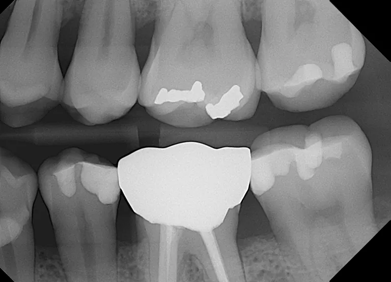 Open Sensor<br>Dental  X-Ray Sensor - Image 2